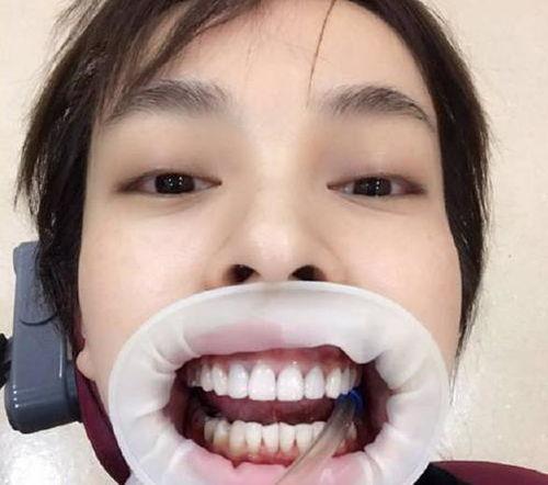 明星看牙,明星们如何优雅面对看牙挑战